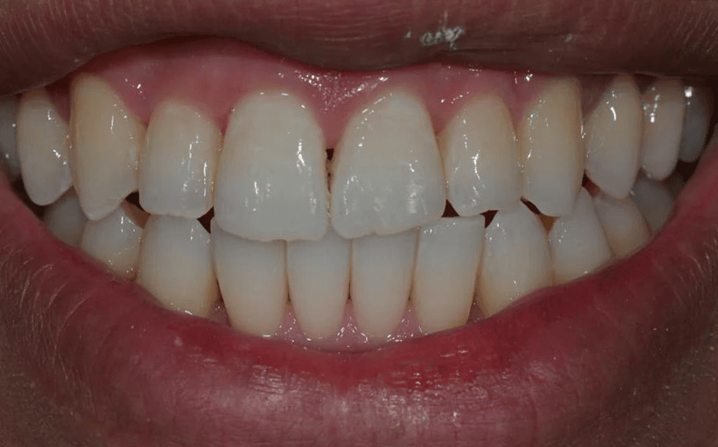 Adam after treatment