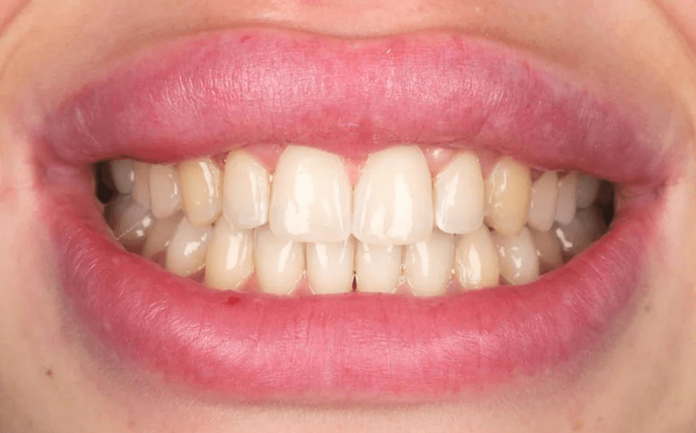 Poppy after treatment