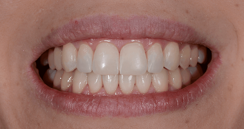 Simon after treatment