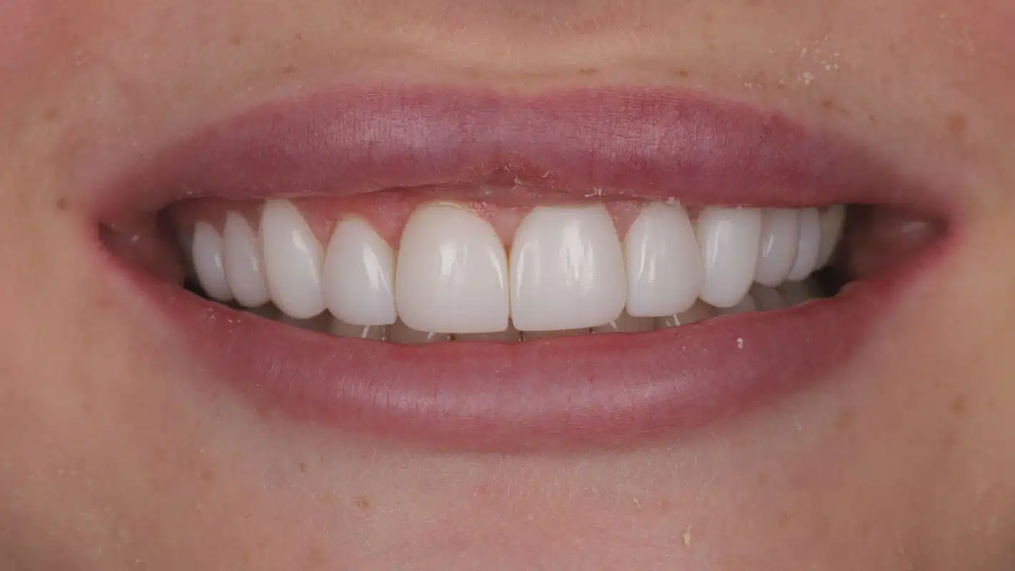 Sophie after treatment