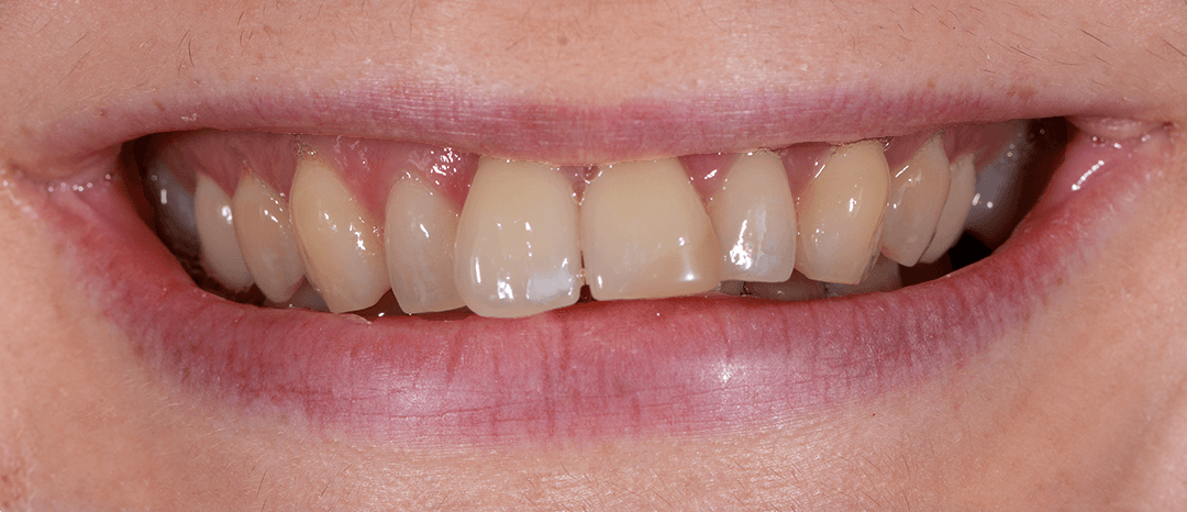 Peta before treatment