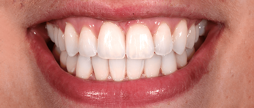 Natalie after treatment